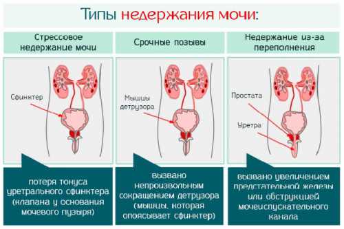 Как правило, является результатом опухоли, инфекции или травмы спинного мозга, который разрушает нервы, которые контролируют мочевой пузырь