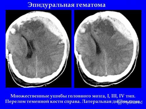 Гематома головного мозга