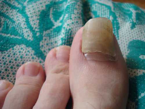 Есть несколько факторов, которые увеличивают риск врастания ногтя ортопедические деформации стоп плоскостопие и особенно вальгусная деформация большого пальца неправильный педикюр, когда ногти отрезаются очень коротко или выстригаются их боковые углы