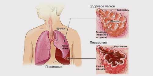 Признаки воспаления лёгких у взрослых, причины,