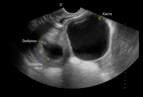 Киста желтого тела при беременности