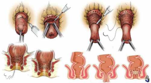 Лечение выпадения прямой кишки в домашних