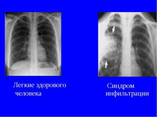 Что показывает флюорография