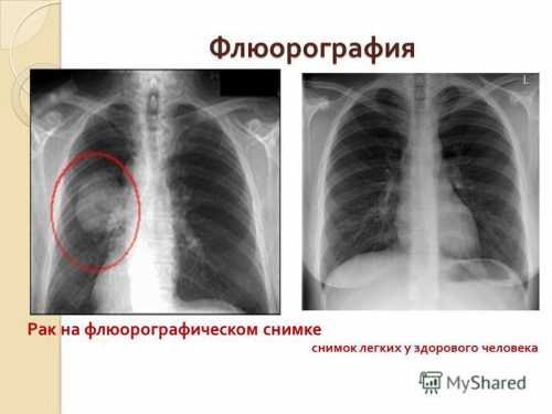 Что показывает флюорография