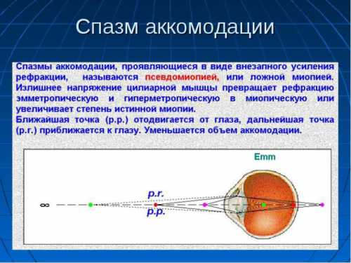 Спазм аккомодации