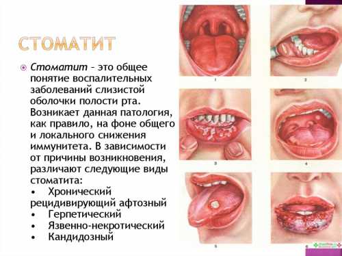 Стоматит у детей: виды, основные симптомы и