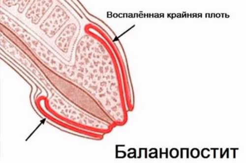 Без необходимого лечения осложнения могут быть довольно серьезными